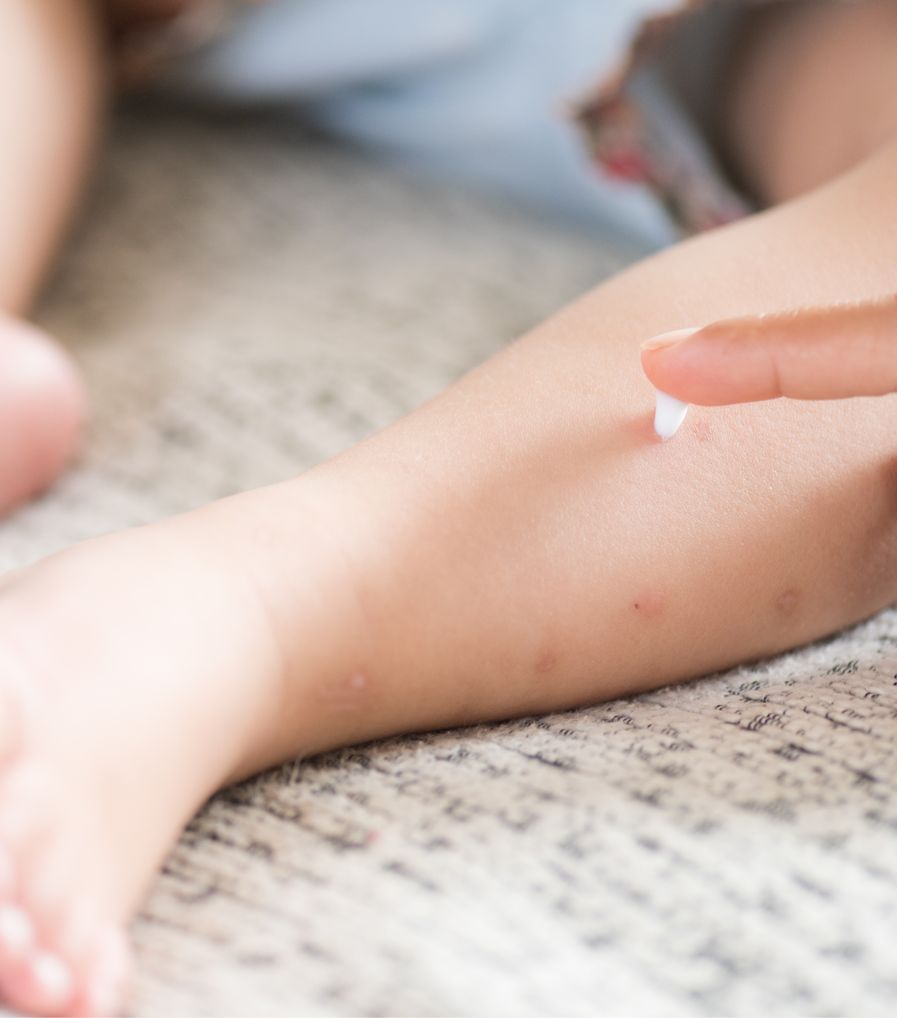 crema cicatriz varicela